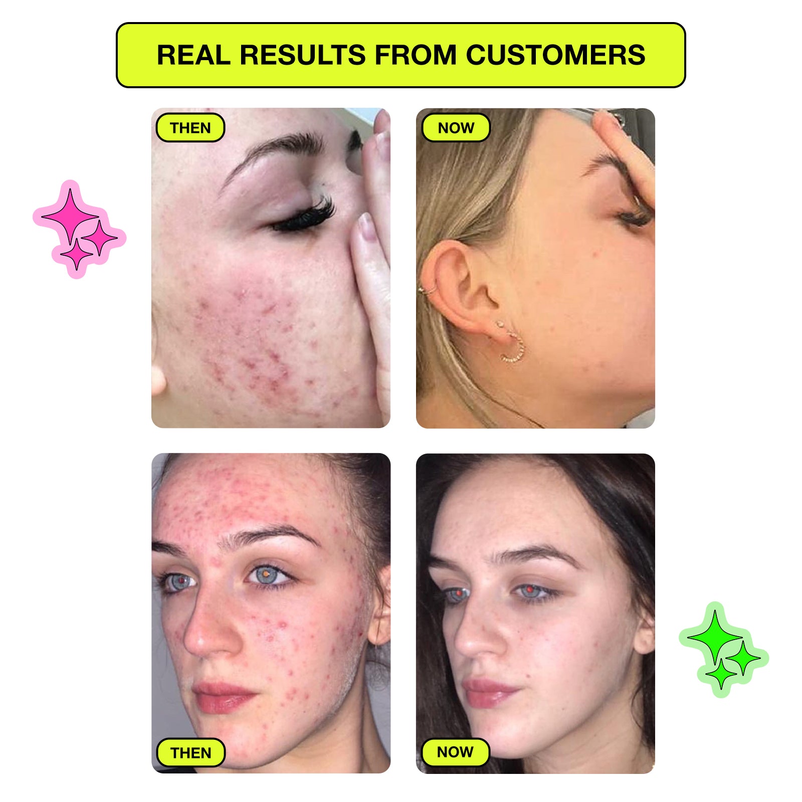 Zap Patch - Salicylic Acid Spot Patches