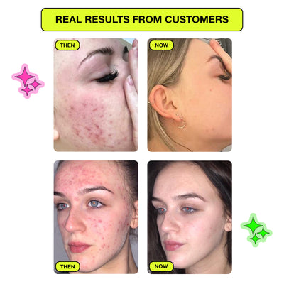 Zap Patch - Salicylic Acid Spot Patches